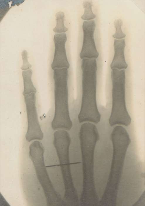 x-ray, Iowa History, Hospitals, Cook, Mavis, Iowa, Labor and Occupations, hand, Hubbard, IA, history of Iowa, bones